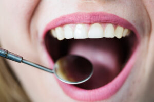 Jak rozpoznać starte szkliwo zębów?