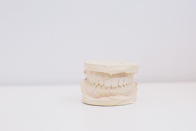 All on 4 – na czym polega odbudowa zębów na implantach?